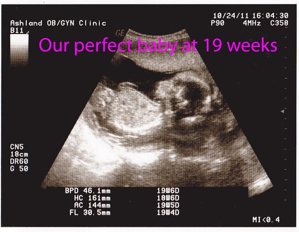 My Baby Story ~ journey with a subchorionic hematoma